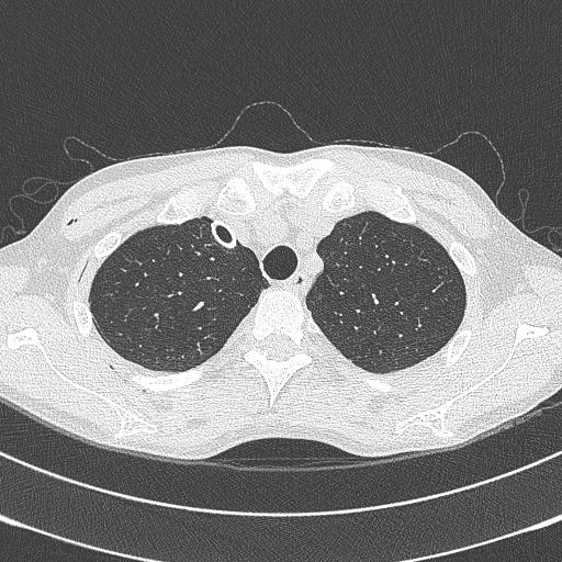 CT-LUNG-2.jpg